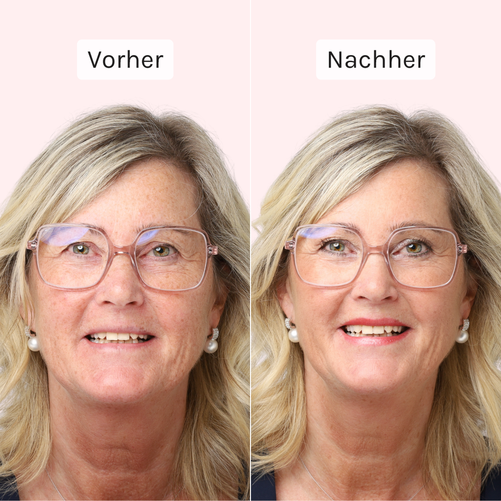 Cosline Vorher Nachher Bild Ü60